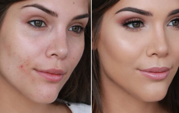 How To Make a Pimple Disappear With Makeup